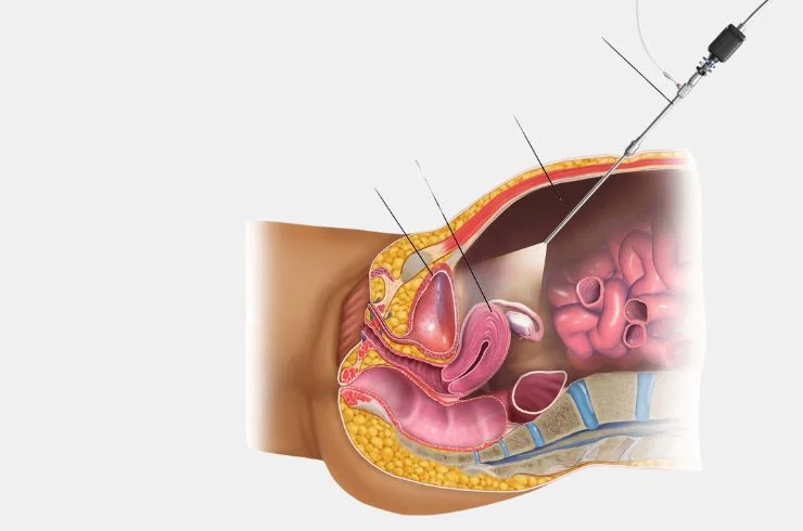 Diagnostic Laparoscopy & Tubal Testing