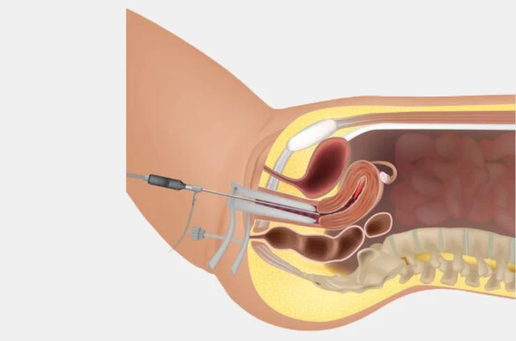 Hysteroscopy