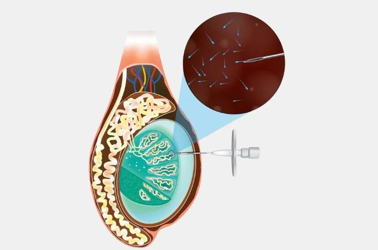 TESA (Testicular Sperm Aspiration)