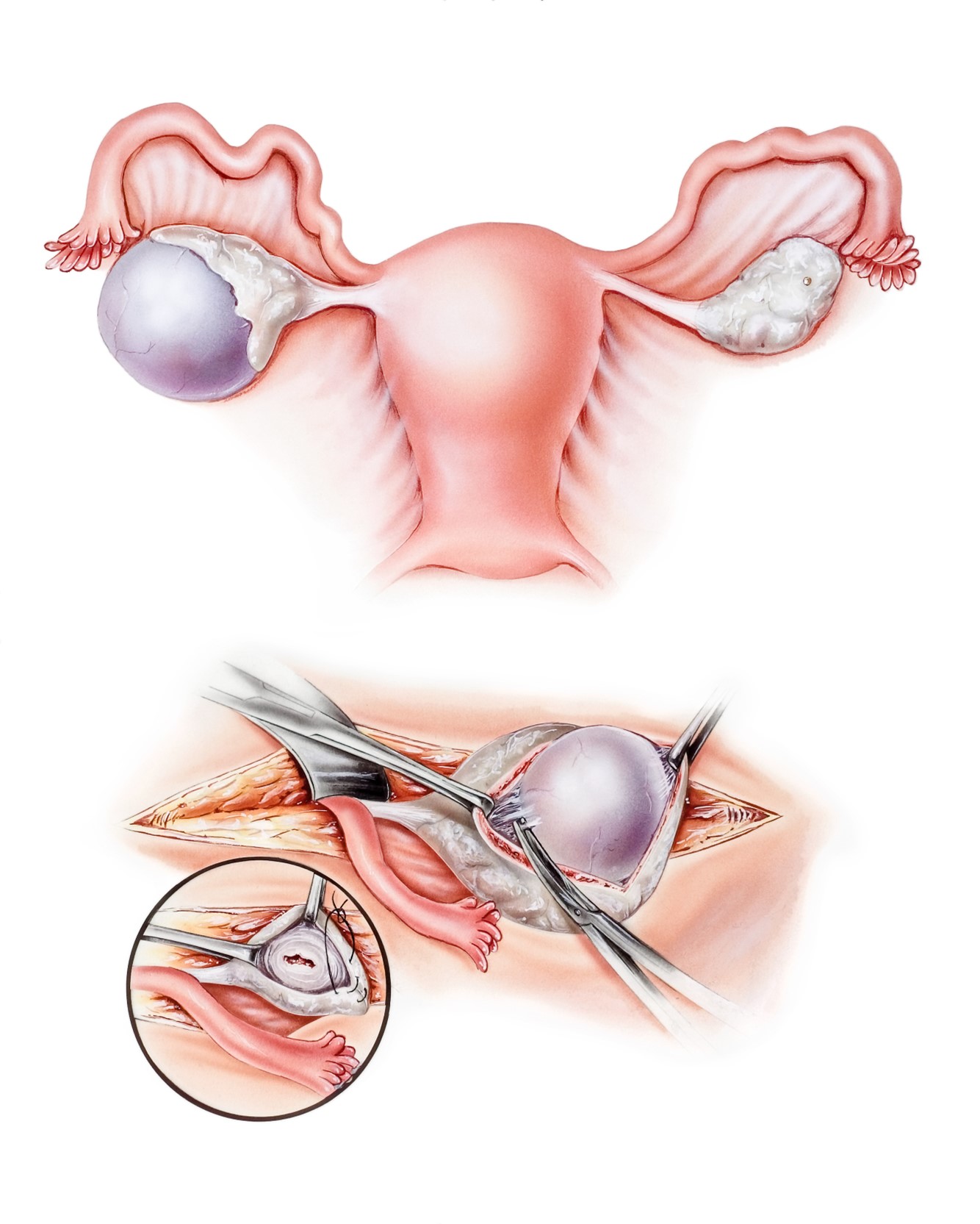 Beyond the Basics: Exploring Ovarian Cysts and Their Impact