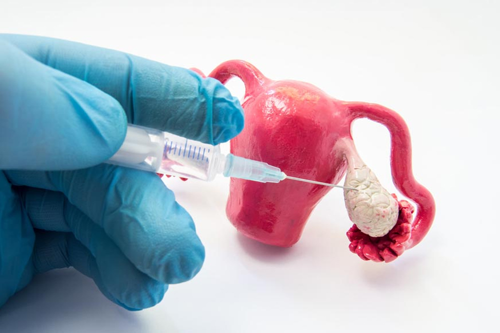 Understanding Ovarian Stimulation in IVF: What It Is and How It Works